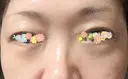 クマ治療 / 下まぶたの脂肪取り 東郷美容形成外科　福岡 DAY 5 サムネイル用