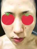 ピーリング（ニキビ・毛穴） / イオン導入 / フォトシルクプラス / ニキビ治療 ハニークリニック DAY 10 サムネイル用