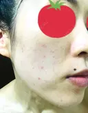 ピーリング（ニキビ・毛穴） / イオン導入 / フォトシルクプラス / ニキビ治療 ハニークリニック DAY 10 サムネイル用