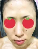 ピーリング（ニキビ・毛穴） / イオン導入 / フォトシルクプラス / ニキビ治療 ハニークリニック DAY 10 サムネイル用