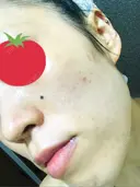 ピーリング（ニキビ・毛穴） / イオン導入 / フォトシルクプラス / ニキビ治療 ハニークリニック DAY 10 サムネイル用