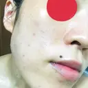 ピーリング（ニキビ・毛穴） / イオン導入 / フォトシルクプラス / ニキビ治療 ハニークリニック DAY 10 サムネイル用