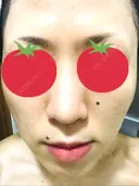 ピーリング（ニキビ・毛穴） / イオン導入 / フォトシルクプラス / ニキビ治療 ハニークリニック DAY 11 サムネイル用