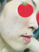 ピーリング（ニキビ・毛穴） / イオン導入 / フォトシルクプラス / ニキビ治療 ハニークリニック DAY 11 サムネイル用