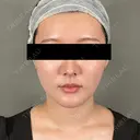 糸リフト / 脂肪吸引（顔） / ジョールファット除去 アリエル美容クリニック 大宮院 DAY 31 サムネイル用