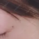 アートメイク（ほくろ） oneUPclinic AFTER サムネイル用