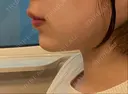 ヒアルロン酸注入（あご） プライベートスキンクリニック 梅田本院 DAY 0 サムネイル用