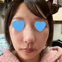 隆鼻術 / 鼻尖形成（切開） / 鼻中隔延長（切開） / 軟骨移植 / 骨切幅寄せ / 真皮移植 Zetith Beauty Clinic 銀座院 DAY 238 サムネイル用