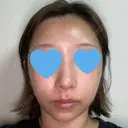 隆鼻術 / 鼻尖形成（切開） / 鼻中隔延長（切開） / 軟骨移植 / 骨切幅寄せ / 真皮移植 Zetith Beauty Clinic 銀座院 AFTER サムネイル用