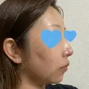隆鼻術 / 鼻尖形成（切開） / 鼻中隔延長（切開） / 軟骨移植 / 骨切幅寄せ / 真皮移植 Zetith Beauty Clinic 銀座院 DAY 346 サムネイル用