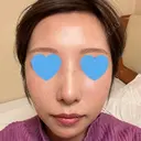 隆鼻術 / 鼻尖形成（切開） / 鼻中隔延長（切開） / 軟骨移植 / 骨切幅寄せ / 真皮移植 Zetith Beauty Clinic 銀座院 DAY 73 サムネイル用