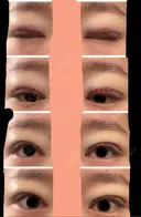 二重切開 / 眼瞼下垂（切開） / 上まぶたたるみ取り / 上まぶたの脂肪取り 城本クリニック 名古屋院 DAY 0 サムネイル用