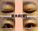 二重切開 / 眼瞼下垂（切開） / 上まぶたたるみ取り / 上まぶたの脂肪取り 城本クリニック 名古屋院 DAY 5 サムネイル用