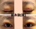 二重切開 / 眼瞼下垂（切開） / 上まぶたたるみ取り / 上まぶたの脂肪取り 城本クリニック 名古屋院 DAY 5 サムネイル用