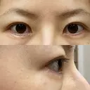 二重切開 / 目尻切開 / 上まぶたの脂肪取り / タレ目形成・グラマラスライン（切開） LIKI CLINIC KOBE AFTER サムネイル用