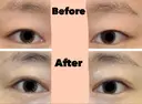 二重切開 / 眼瞼下垂（切開） / 上まぶたたるみ取り / 上まぶたの脂肪取り 城本クリニック 名古屋院 AFTER サムネイル用