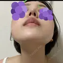 鼻尖形成（切開） / 軟骨移植 / ヒアルロン酸注入（涙袋） / ヒアルロン酸注入（唇） / ボトックス（口角） / ヒアルロン酸注入（額） 東京シンデレラ美容外科 池袋院 DAY 8 サムネイル用