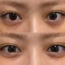 ヒアルロン酸注入（涙袋） フィラークリニック 大阪心斎橋院 DAY 4 サムネイル用