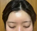 ヒアルロン酸注入（額） / ヒアルロン酸注入（こめかみ） BRIGHTS beauty clinic AFTER サムネイル用