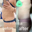 脂肪冷却（お腹） 品川スキンクリニック神戸院（※品川美容外科提携） AFTER サムネイル用