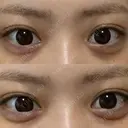 ヒアルロン酸注入（涙袋） フィラークリニック 大阪心斎橋院 DAY 6 サムネイル用