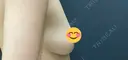 豊胸（脂肪注入） 銀座マイアミ美容外科 DAY 297 サムネイル用