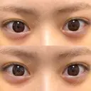 ヒアルロン酸注入（涙袋） フィラークリニック 大阪心斎橋院 DAY 7 サムネイル用