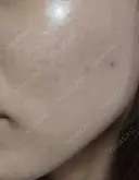 ピーリング（ニキビ・毛穴） 表参道スキンクリニック 大阪院 DAY 0 サムネイル用