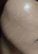 ピーリング（ニキビ・毛穴） 表参道スキンクリニック 大阪院 DAY 0 サムネイル用