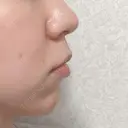 ヒアルロン酸注入（あご） / ボトックス（エラ・小顔） 川越TAクリニックアソシエ DAY 16 サムネイル用