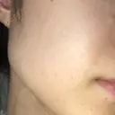 美容点滴・美容注射（疲労回復） 麗ビューティー皮フ科クリニック　大阪高槻院 AFTER サムネイル用