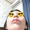 鼻尖形成（非切開） / 鼻中隔延長（非切開） ルラ美容クリニック銀座院 DAY 1 サムネイル用