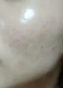 ピーリング（ニキビ・毛穴） 表参道スキンクリニック 大阪院 DAY 3 サムネイル用