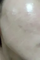 ピーリング（ニキビ・毛穴） 表参道スキンクリニック 大阪院 DAY 3 サムネイル用