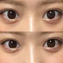 ヒアルロン酸注入（涙袋） フィラークリニック 大阪心斎橋院 AFTER サムネイル用