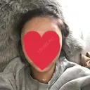 バッカルファット除去 / 脂肪吸引（顔） / 額を丸く / ヒアルロン酸注入（あご） / ボトックス（エラ・小顔） / ヒアルロン酸注入（額） エートップ美容整形外科 DAY 11 サムネイル用