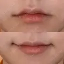 ヒアルロン酸注入（唇） / ボトックス（口角） グランメドクリニック茨木 DAY 0 サムネイル用
