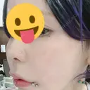 鼻尖形成（非切開） / 鼻中隔延長（非切開） ルラ美容クリニック銀座院 DAY 4 サムネイル用