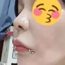 鼻尖形成（非切開） / 鼻中隔延長（非切開） ルラ美容クリニック銀座院 DAY 4 サムネイル用