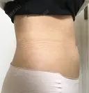 脂肪吸引（お腹） ドクターフィット（Dr.fit）クリニック DAY 50 サムネイル用