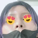 鼻尖形成（非切開） / 鼻中隔延長（非切開） ルラ美容クリニック銀座院 DAY 5 サムネイル用
