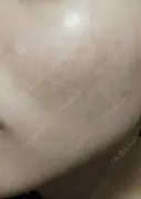 ピーリング（ニキビ・毛穴） 表参道スキンクリニック 大阪院 DAY 5 サムネイル用