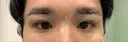 眉下切開 くさのたろうクリニック DAY 0 サムネイル用