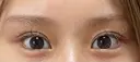 目尻靭帯移動 R.O.clinic AFTER サムネイル用