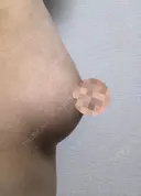 脂肪吸引（お腹） / 脂肪吸引（お尻） / 豊胸（脂肪注入） / その他（ボディ） ドクターフィット（Dr.fit）クリニック DAY 60 サムネイル用