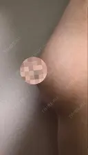 脂肪吸引（お腹） / 脂肪吸引（お尻） / 豊胸（脂肪注入） / その他（ボディ） ドクターフィット（Dr.fit）クリニック DAY 60 サムネイル用