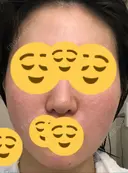 ほくろ・いぼ切除（肌） / その他（肌） / 美肌レーザー / シミ取りレーザー / 美白レーザー クロスクリニック銀座 AFTER サムネイル用