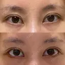 目尻切開 / タレ目形成・グラマラスライン（切開） eクリニック 金沢本院 DAY 24 サムネイル用