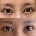 目尻切開 / タレ目形成・グラマラスライン（切開） eクリニック 金沢本院 DAY 26 サムネイル用