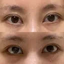 目尻切開 / タレ目形成・グラマラスライン（切開） eクリニック 金沢本院 DAY 27 サムネイル用